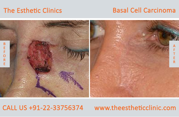 Basal Cell Carcinoma Treatment Surgery before after photos in mumbai india (2)